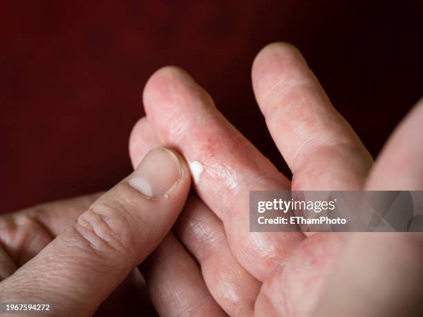 applying hand cream on atopic dermatitis eczema on fingers - atopic dermatitis stock-fotos und bilder