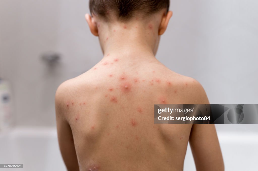 Smallpox Minor Rash Boy With Chickenpox Rash On Child Body Close Up High-Res Stock Photo ...