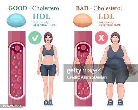 Types of cholesterol in the blood concept. High-Density Lipoprotein (HDL) and Low-Density Lipoprotein (LDL). Types of cholesterol in the blood concept. High-Density Lipoprotein (HDL) and Low-Density Lipoprotein (LDL).