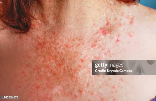 red skin rash with bumps, scabs - psoriasis skin - skin rash stock pictures, royalty-free photos & images