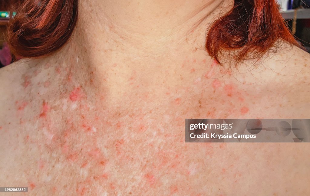 Red Skin Rash With Bumps, Scabs - Psoriasis Skin