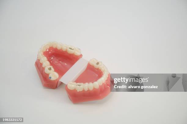 dental model with transparent aligners - dentures stock pictures, royalty-free photos & images