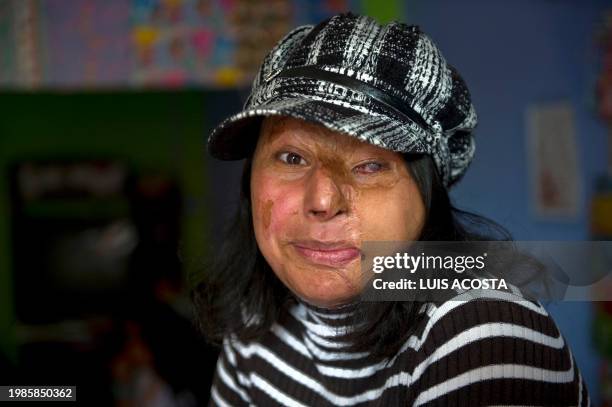 Colombian Maria Cuervo poses at her home in Bogota on March 5, 2012. Cuervo was burnt with acid on March 8, 2004. In Colombia such aggressions are...