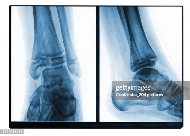 X Rays Tibia Normal 596 Tibia X Ray Stock Photos, High-Res Pictures, and Images - Getty Images