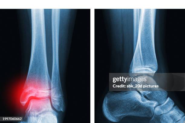 woman foot 06 - knochenbruch stock-fotos und bilder