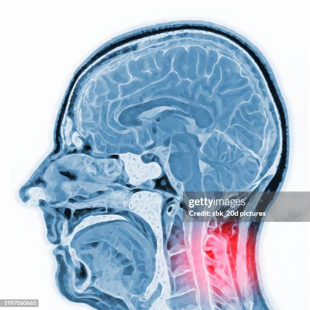 skull mri 01 - ibuprofen stock pictures, royalty-free photos & images