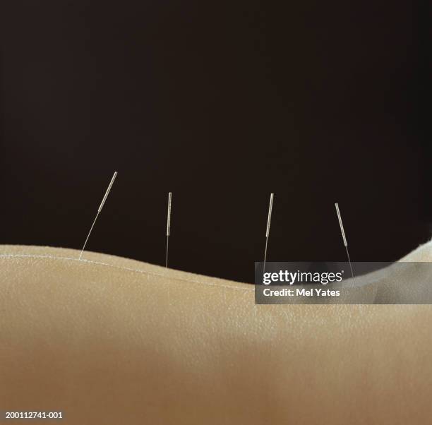 woman with acupuncture needles in lower back, close-up - acupuncture stock-fotos und bilder