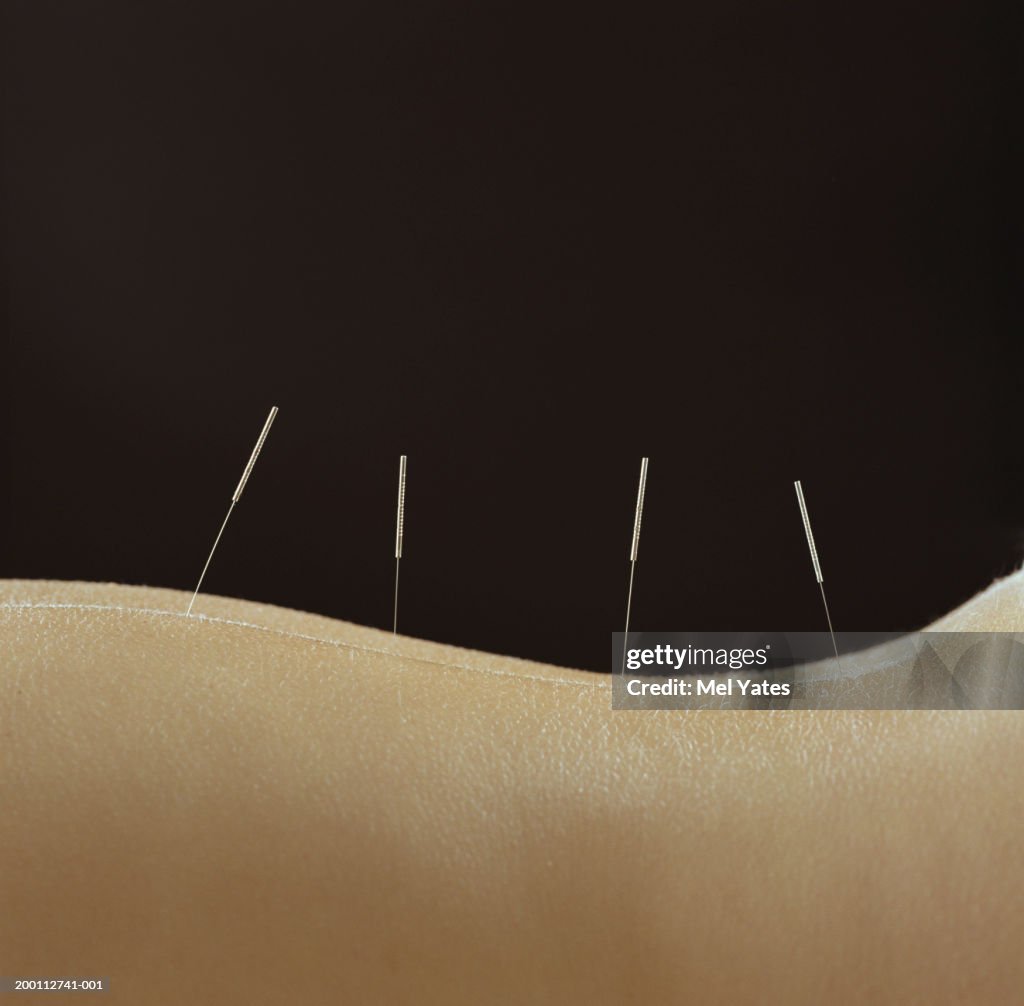 Woman with acupuncture needles in lower back, close-up
