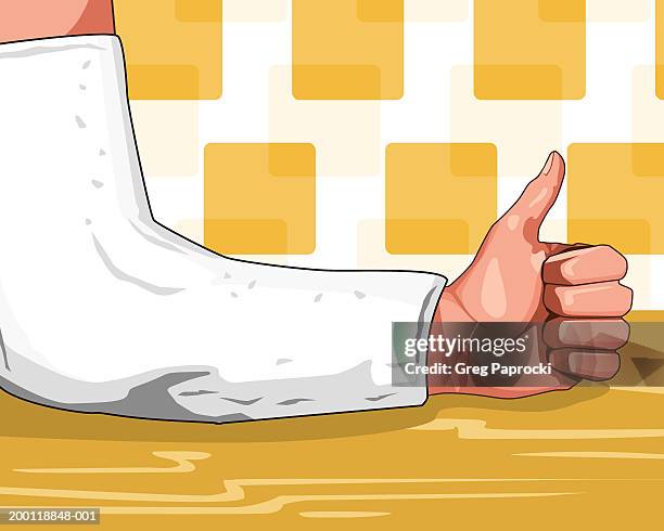 man with arm in cast, close-up - close up of arm in cast stock-grafiken, -clipart, -cartoons und -symbole