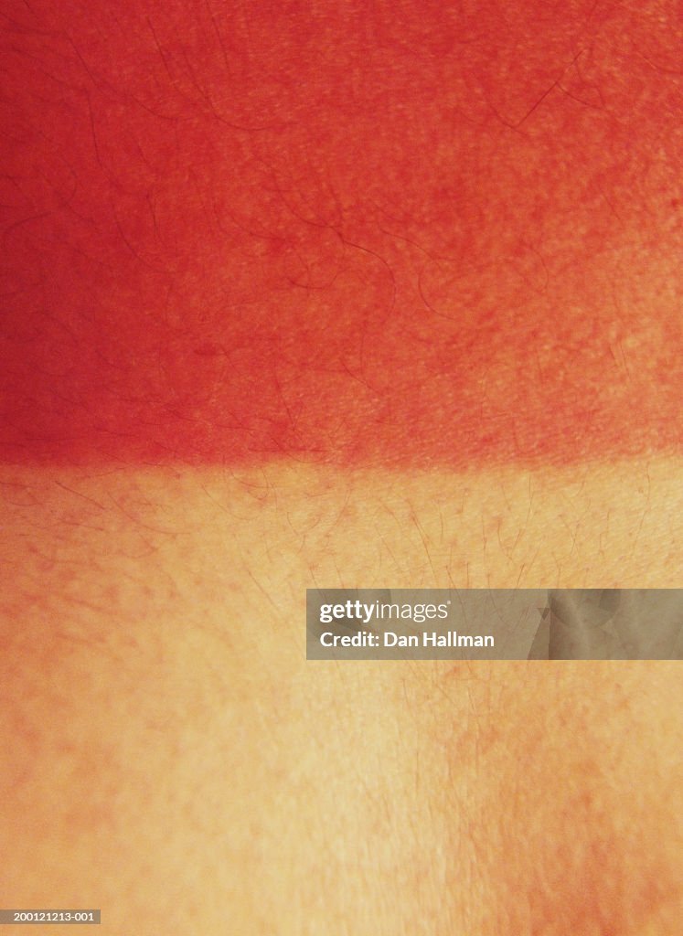 Sunburned skin (detail)