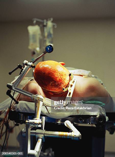 patient with shaved head in clamp, lying on operating table - neurocirugia fotografías e imágenes de stock