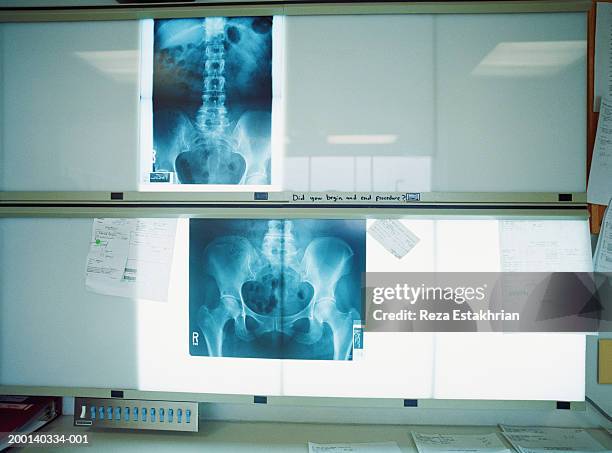 hip and back x-rays on lightbox - röntgen stockfoto's en -beelden