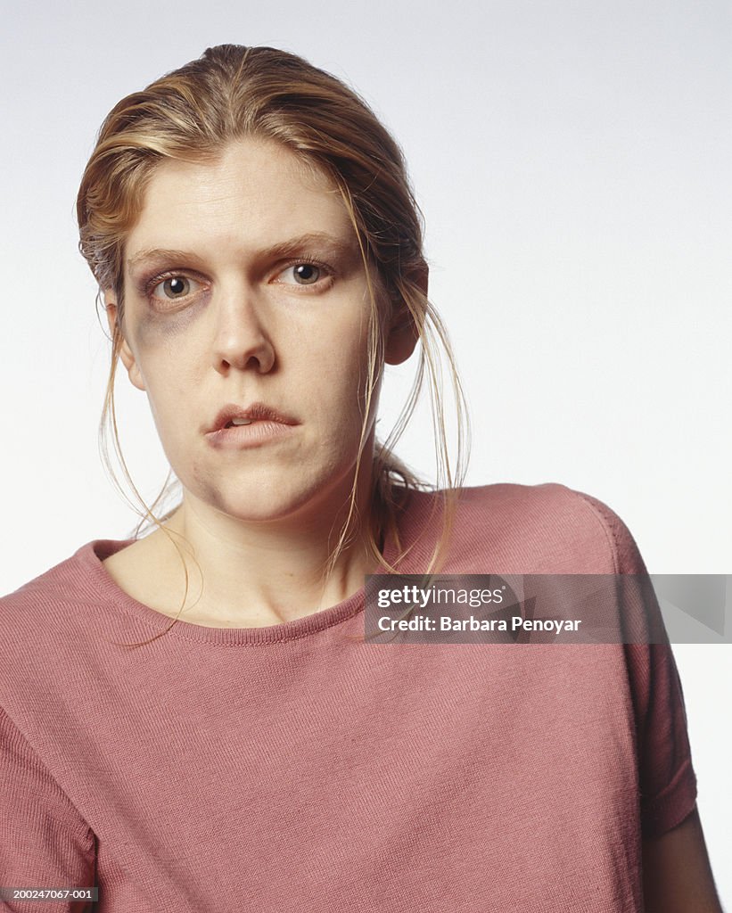 Battered woman with black-eye, posing in studio, (Portrait)