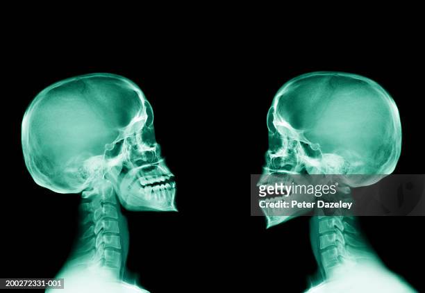 x-ray of two human skulls, side view - human jaw bone stockfoto's en -beelden