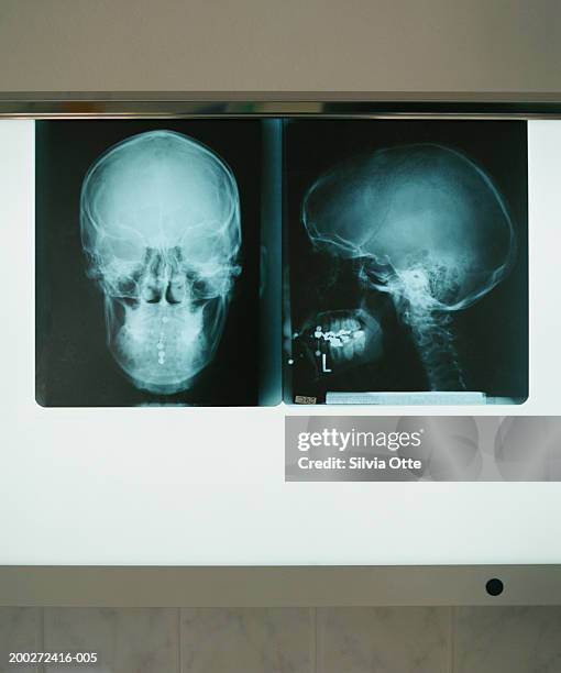 two x-rays of skull, frontal and side views - lightbox stock-fotos und bilder