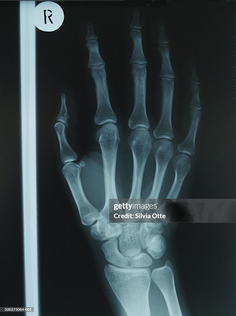 X-ray of right hand, close-up