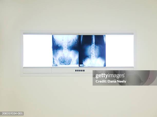 x-rays on lightbox - leuchtkasten stock-fotos und bilder