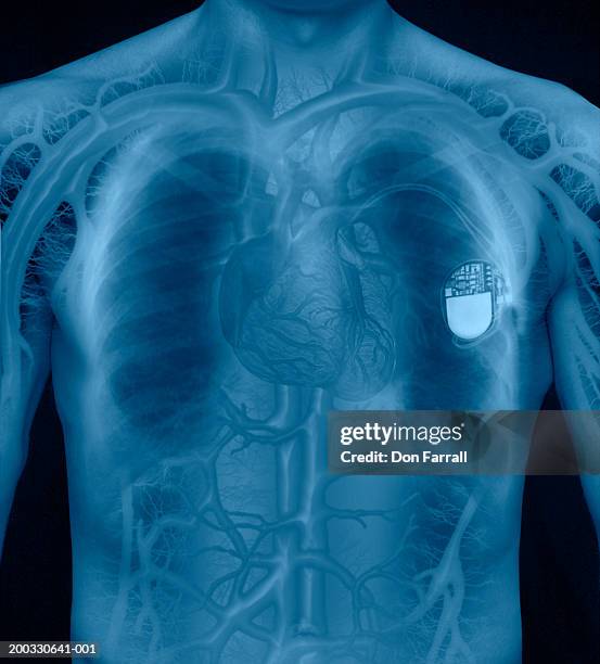 Foto Pacemaker 1.350 Pacemaker Stock Photos, High-Res Pictures, and Images - Getty Images