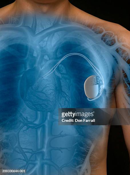 man with pacemaker, mid section (digital composite) - a v pacemaker stock pictures, royalty-free photos & images