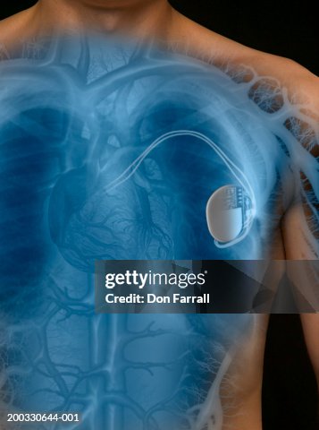 Man with pacemaker, mid section (Digital Composite) Man with pacemaker, mid section (Digital Composite)