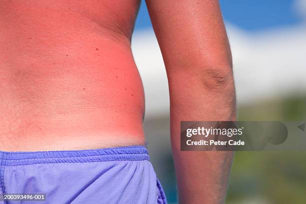 man with sunburnt back, mid section, close-up - coup de soleil photos et images de collection