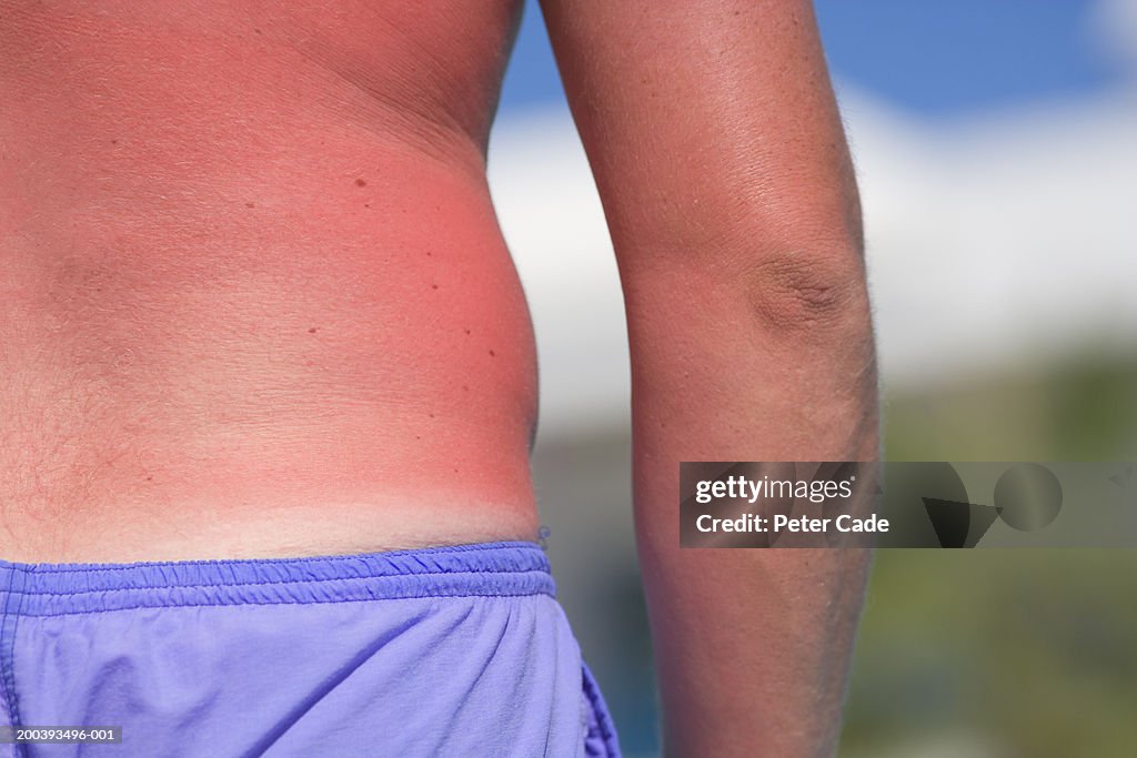 Man with sunburnt back, mid section, close-up
