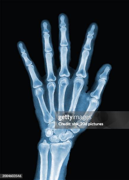 hand woman 08 - röntgenbild bildbanksfoton och bilder