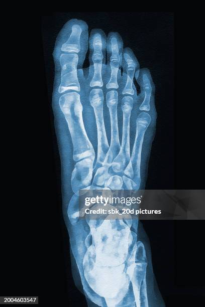 girl one feet 03 - röntgenaufnahme stock-fotos und bilder