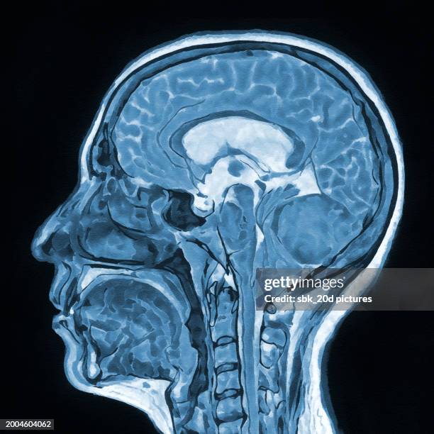 woman skull mri 03 - ibuprofen stock pictures, royalty-free photos & images