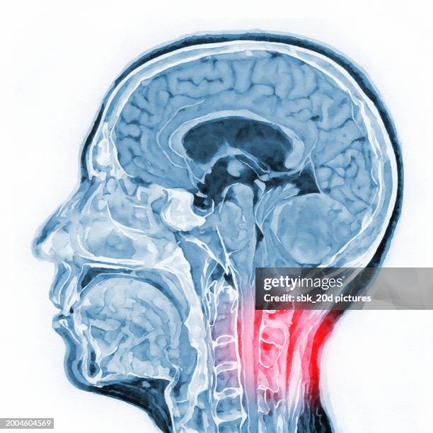 woman skull mri 02 - ibuprofen stock pictures, royalty-free photos & images