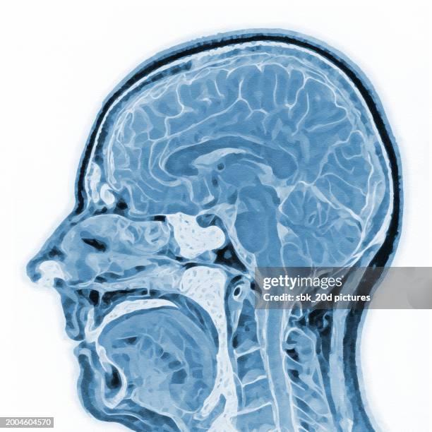 skull mri 02 - ibuprofen stock pictures, royalty-free photos & images