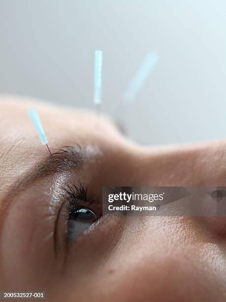 woman undergoing acupuncture treatment, close-up - acupuncture needle stock pictures, royalty-free photos & images