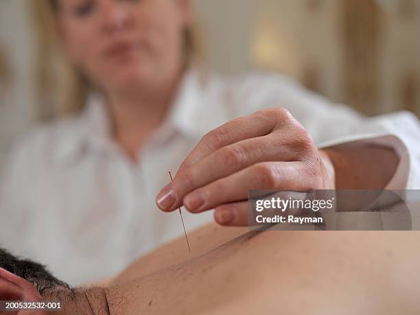 healthcare worker placing acunpuncture needle on patient - acupuncture - fotografias e filmes do acervo