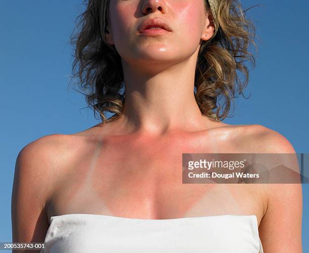 young woman with sunburn tanlines, mid section - sunburn stock-fotos und bilder