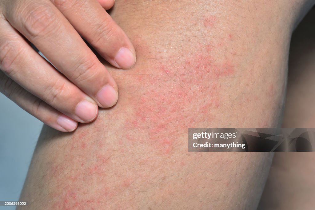 Lower Extremity Allergic Rashes Red Allergic Rash On The Leg Skin From Atopic Dermatitis High-Res Stock ...