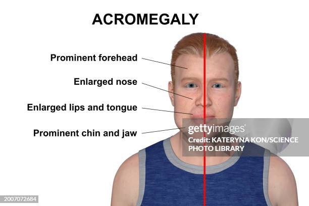 acromegaly in a man compared to healthy man, illustration - acromegaly stock illustrations