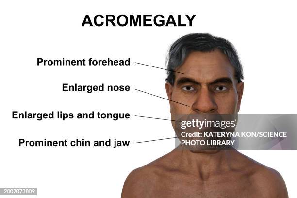 acromegaly in a man compared to healthy man, illustration - distorted body stock illustrations