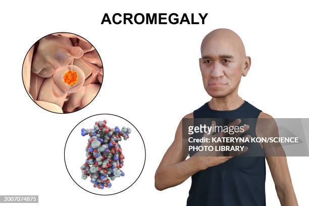 acromegaly, illustration - human head stock illustrations