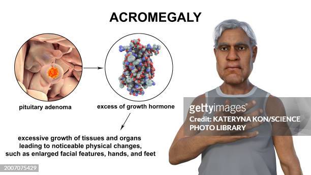 acromegaly, illustration - brain tumour stock illustrations
