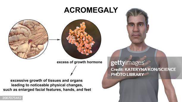 acromegaly, illustration - acromegaly stock illustrations