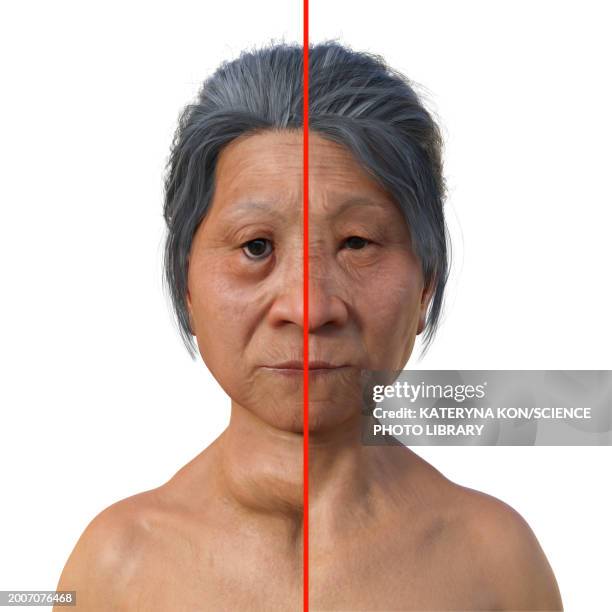 graves' disease, illustration - distorted body stock illustrations