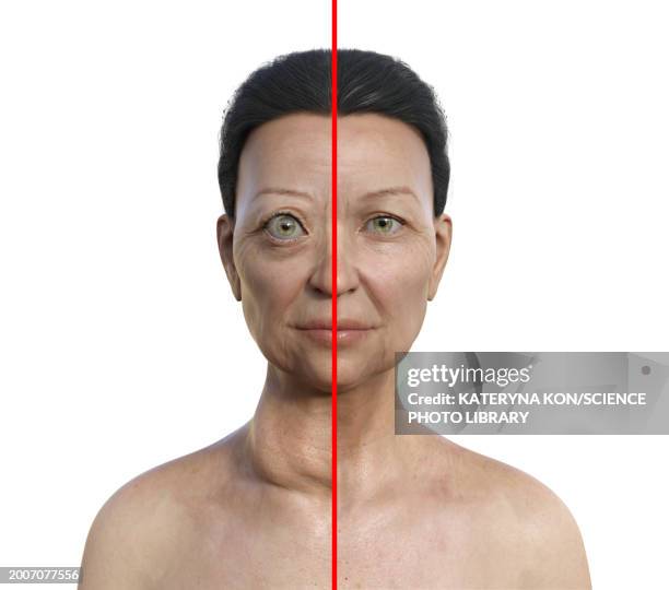 woman with graves' disease, illustration - thyroid eye disease stock illustrations