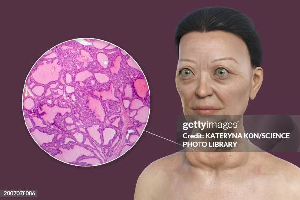 woman with graves' disease, illustration - autoimmune disease stock illustrations