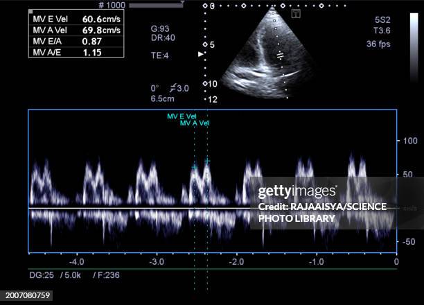 diastolic dysfunction, echocardiogram - echokardiogramm stock-fotos und bilder