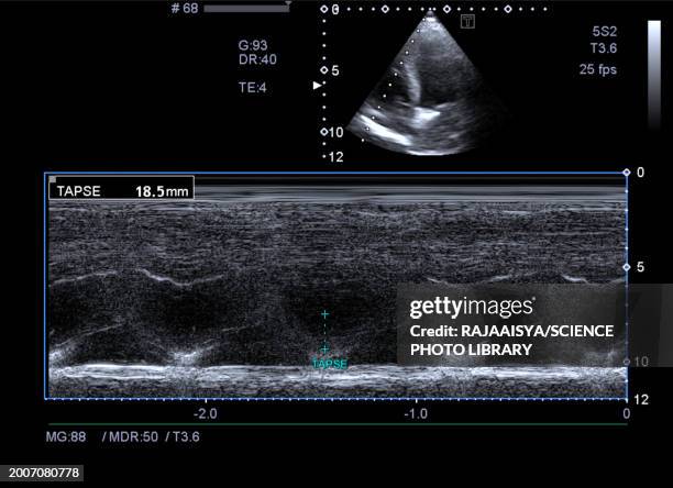 tricuspid annular plane systolic excursion, ultrasound scan - echokardiogramm stock-fotos und bilder