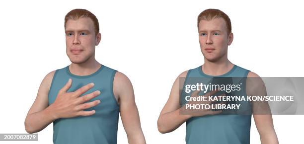 acromegaly in a man compared to healthy man, illustration - rare disease stock illustrations