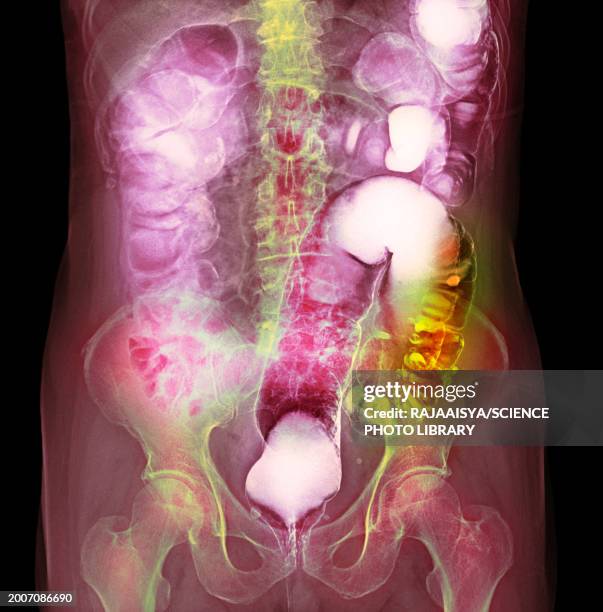 colon diverticula, x-ray - ba stock pictures, royalty-free photos & images