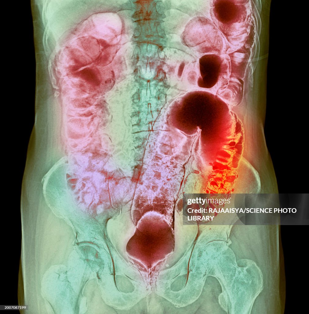 Colon diverticula, X-ray