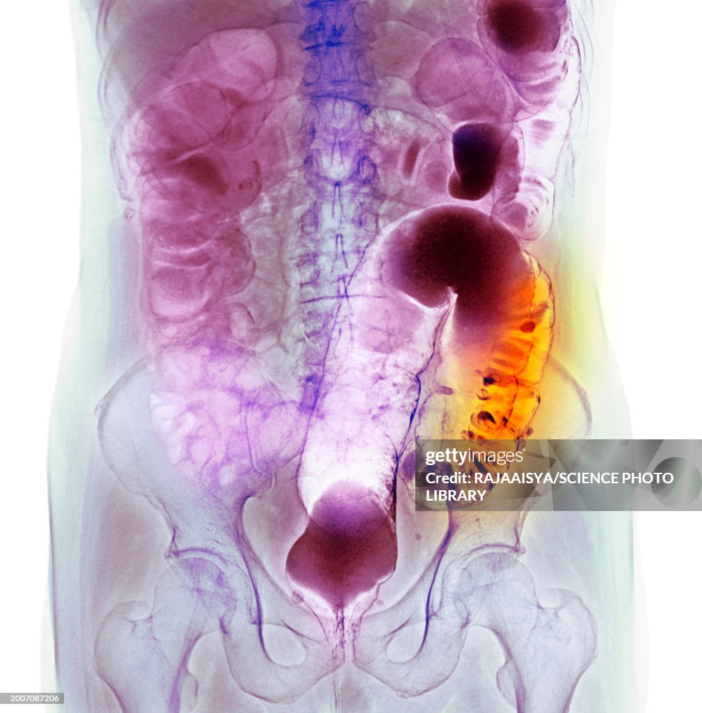 Colon diverticula, X-ray