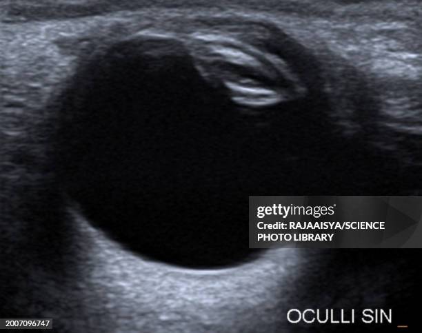 cataract, ocular ultrasound - ultra sonography stock pictures, royalty-free photos & images